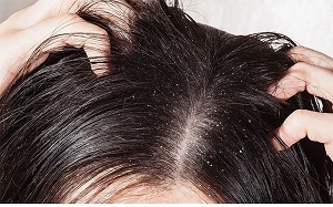 Get Rid of Lice by Following These effective Steps!