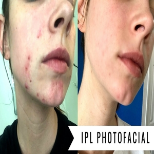 All You Need to Know About IPL Photofacial Treatment