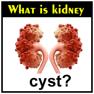 What is kidney cyst?