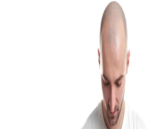 Can Platelet Rich Plasma injections treat hair loss?