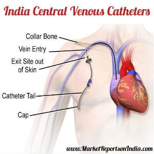 India Central Venous Catheters Market Size, Status, Analysis & forecast 2023 For